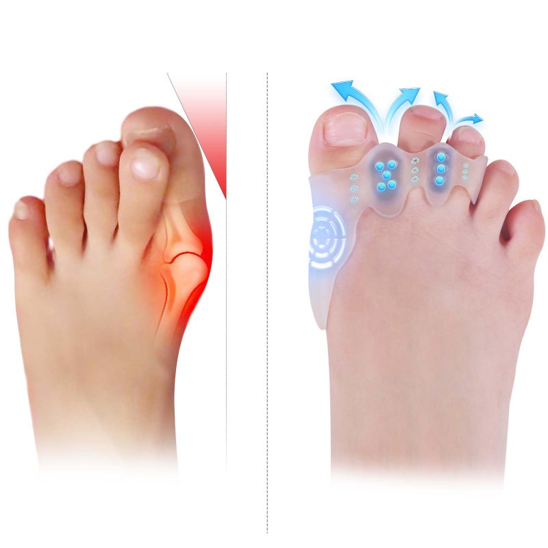 TEVEZO Toe Spacers  Bunion Corrector for Kids  Toe SeparatorsCorn Callus RemoversHammer Toe StraightenerBunion ReliefOverlapping Toes SeparatorsCorn Pads for Toes1 Pair SmallKids